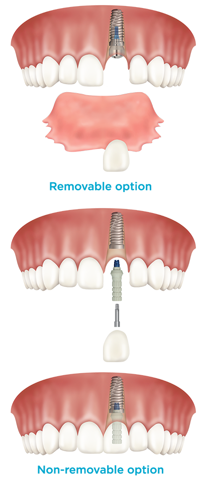Dental implant temporary needed on front tooth? Choices?